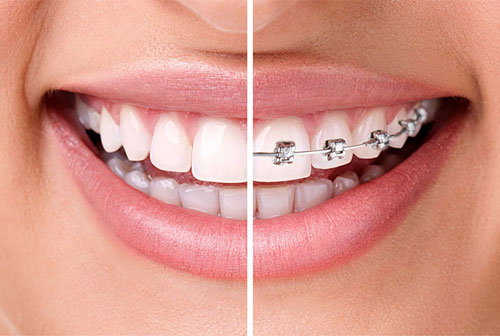 BEST INVISALIGN CLINIC KILPAUK 