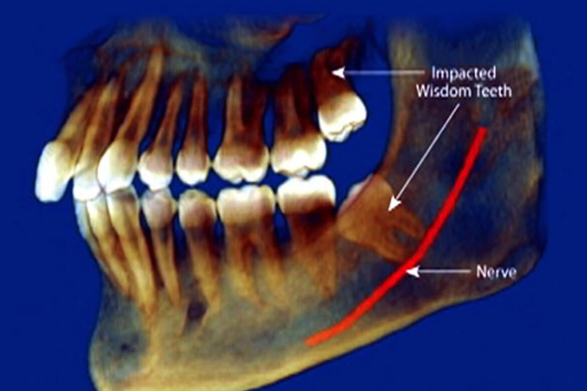 Корни 8 зуба нижней челюсти